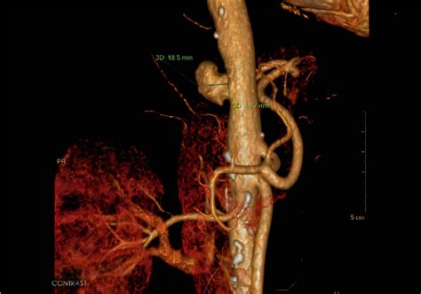 Figure 1 From Mycotic Pseudoaneurysm Of Thoracic Aortic Caused By