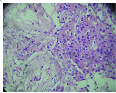 Leydig Cell Hyperplasia Download Scientific Diagram