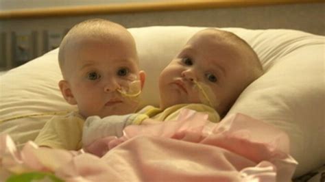 Conjoined Twins Separated At Philadelphia Hospital Video Abc News