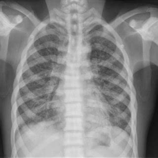 Chest X Ray Posteroanterior View Revealed Ill Defined Reticulonodular