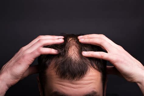 How To Stop Alopecia Areata From Spreading Hair Transplant World