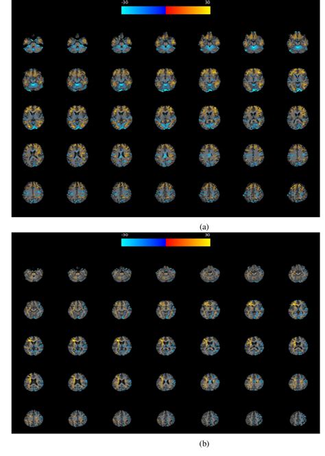 Figure From Hybrid Pet Mri Analysis In The Juvenile Huntington