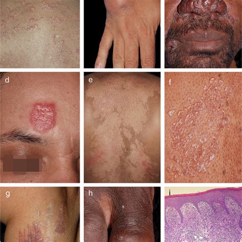 Clinical Characteristics Of 72 Patients With Cuta Neous Sarcoidosis