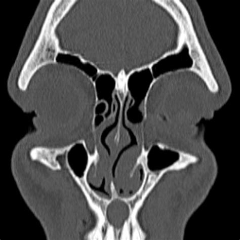 Nasopalatine Duct Cyst NPDC Image Radiopaedia Org