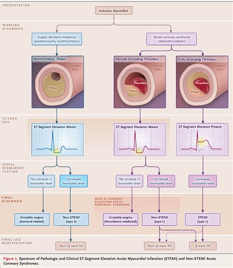 Pdf Acute Myocardial Infarction Semantic Scholar