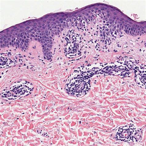 Keratotic Papules And Cutaneous Horns On Left Palmar Region Download