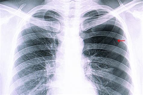 Open Pneumothorax X Ray