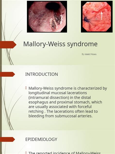 Mallory-Weiss Syndrome | Download Free PDF | Esophagus | Endoscopy