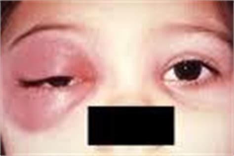 Symptoms - Cretinism (Congenital Hypothyroidism)