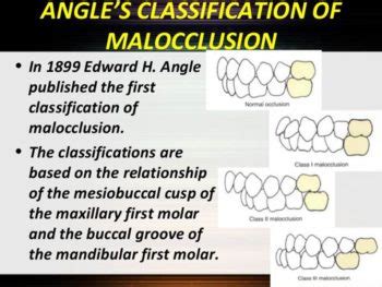 malocclusion-angle-classification-2 - Winchester Dental