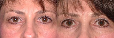 Eyelid Surgery In Charleston Sc Blepharoplasty Near Me