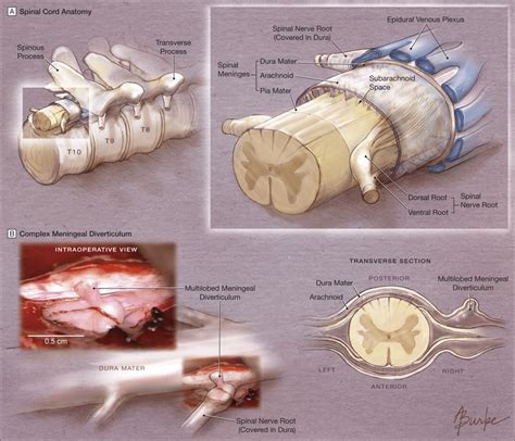 Spontaneous Spinal Cerebrospinal Fluid Leaks And Intracranial