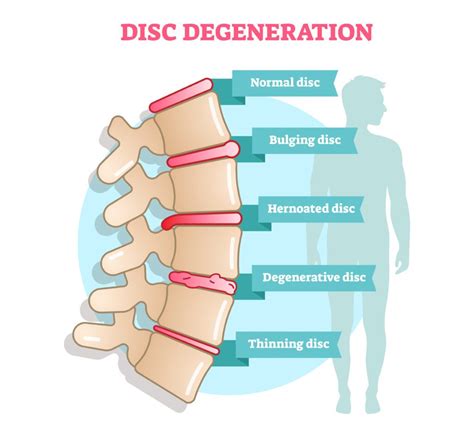 Secure A Va Disability Rating For Degenerative Disc Disease