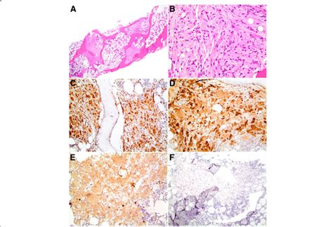 A Bone Marrow Biopsy Shows Cellular Bone Marrow With Trilineage