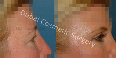 Eyelid Surgery In Dubai Blepharoplasty