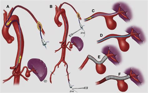 Splenic Artery Aneurysm Treatment Of Choice - Captions Hunter