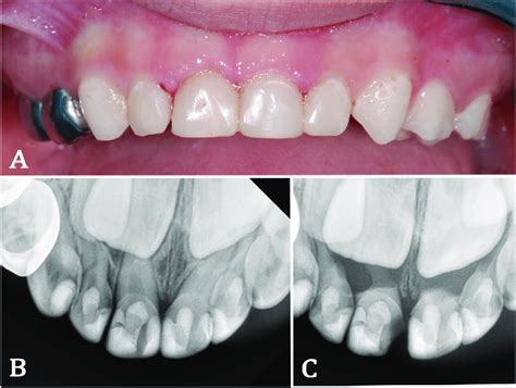 A An Intraoral Photograph Of Maxillary Anterior Primary Teeth Download Scientific Diagram