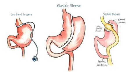 Gastric Bypass Vs Sleeve Pros And Cons Gastric Sleeve Pros And Cons