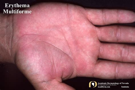 Erythema Multiforme Erythema Exudativum Multiforme Academic Dermatology Of Nevada