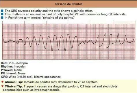 Torsade de pointes | RT | Pinterest | Emergency nursing, Surgical nursing, Medical school studying