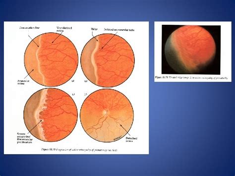 Retinopathy Of Prematurity ROP Proliferative Retinopathy Affects Preterm