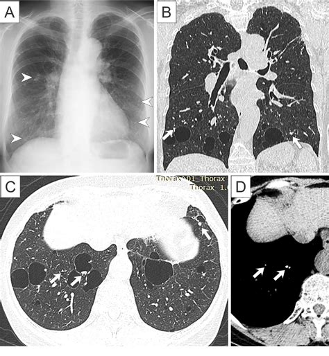 Figure 1 From Nodular Pulmonary Amyloidosis Associated With Sjögrens