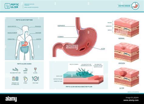 Lcera P Ptica Y Helicobacter Pylori Infogr Fico Con S Ntomas Y Causas