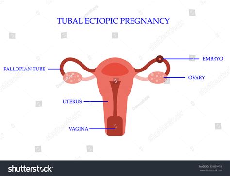 Ectopic Pregnancy Concept Vector Illustration Stock Vector Royalty