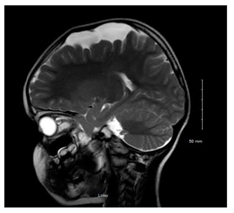 Arachnoid Cyst