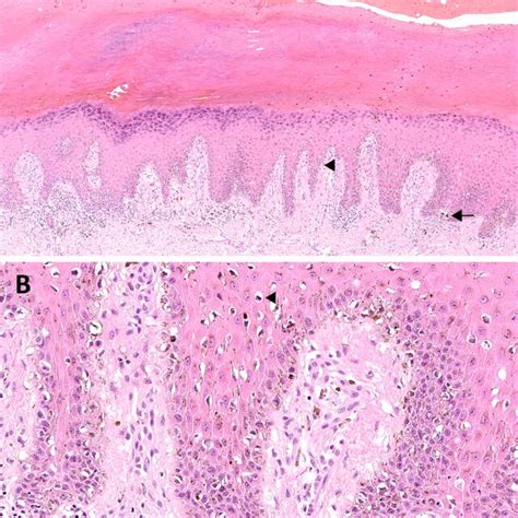 Acral Melanoma A In Situ Acral Lentiginous Melanoma With A