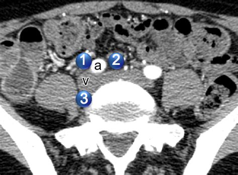 Lymphatic Metastases From Pelvic Tumors Anatomic Classification Characterization And Staging