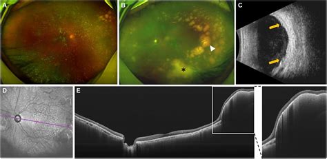 Frontiers Case Report Intraretinal Hyperflow Microinfiltration