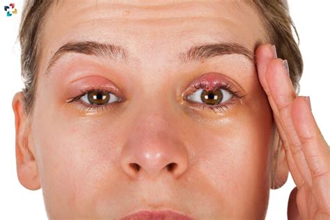 Chalazion Vs Hordeolum Differences Causes Symptoms And Treatment