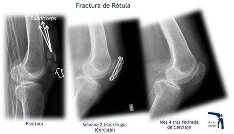 Fractura De Rotula Meseta Tibial Y Fractura De Tibia Juan Arnal