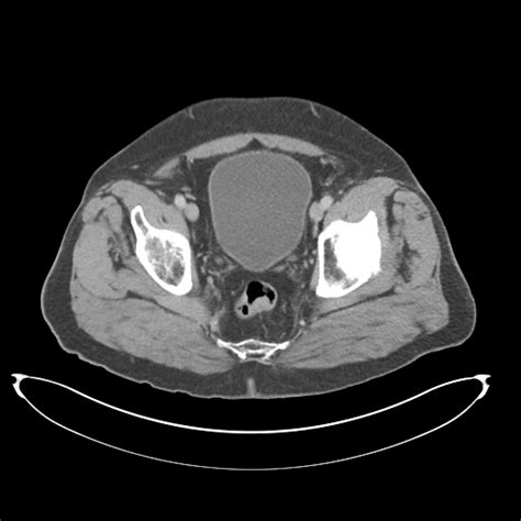 Rectal Cancer T1 Image