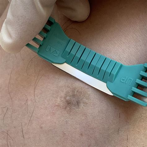 Shave Biopsy And Excision Spot Check Clinic