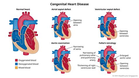 Chronic Heart Disease - Symptoms & Causes | Mount Elizabeth Hospitals