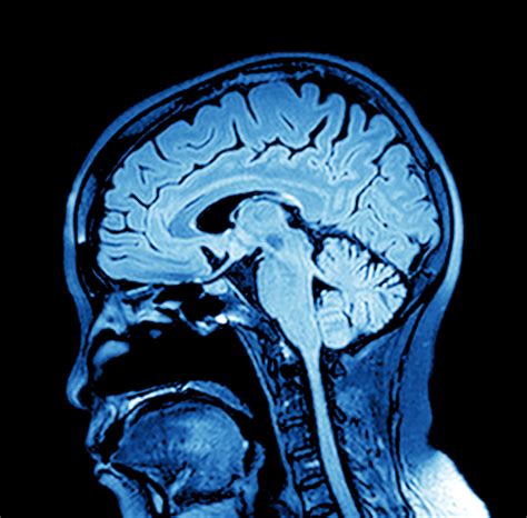 What Multiple Sclerosis Looks Like in Your Brain - My MS Family