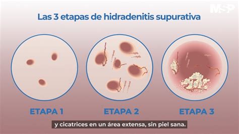 Hidradenitis Supurativa Youtube