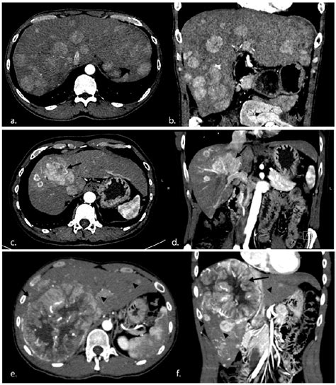 Three Distribution Patterns Of Hepatocellular Carcinoma Hcc On