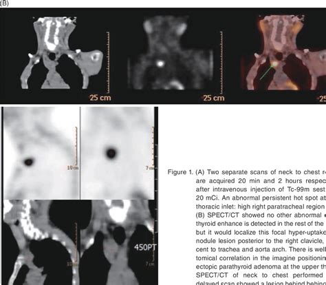 Figure From Retroclavicular Parathyroid Adenoma In A Patient With