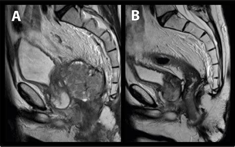 Image Guided Pelvic Exenteration Preoperative And Intraoperative