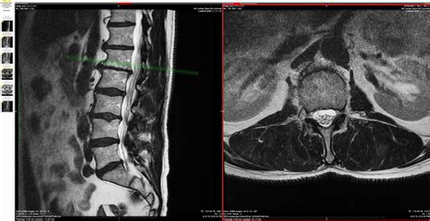 Facet Joint Radiofrequency Denervation London