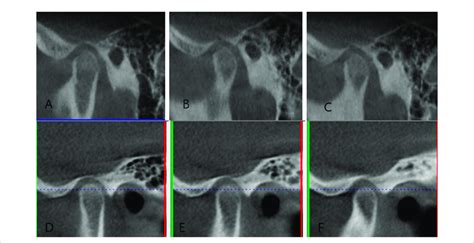 (A-C) Imaging manifestations of the left condylar process before ...