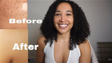 How To Get Rid Of Body Acne No More Bacne 100 Works Youtube