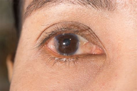 Pterygium Causes And Treatment With Surgery Lsc Eye Clinic