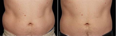 Coolsculpting Elite Prescription Aesthetic And Wellness