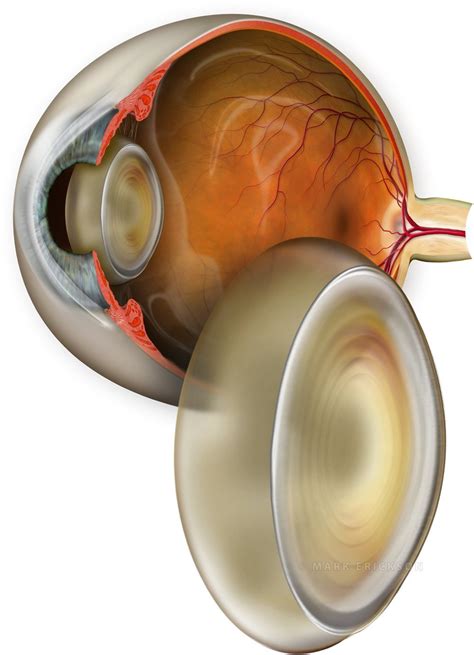 Cataract Cross Section Art With Lens Nucleus And Eyeball