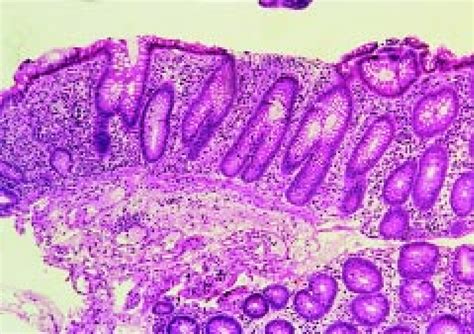 Ulcerative Colitis Mucosal Biopsy Obtained Weeks After The Start