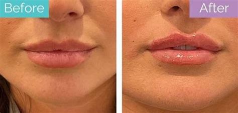 Lip Filler Before And After A Comprehensive Guide To Transforming Your